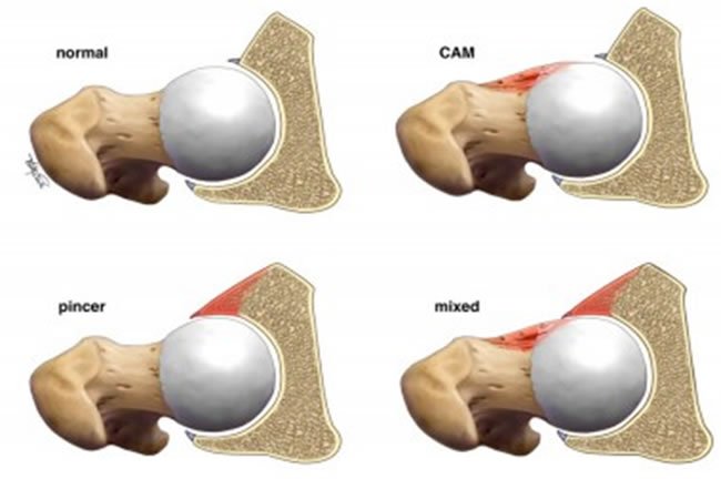 impacto-femoroacetabular-1