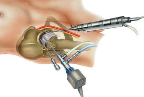 impacto-femoroacetabular-3