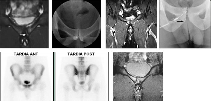 Pubalgia – Dr Lourenço Peixoto – Ortopedia e Traumatologia ...